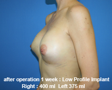 plastic-surgery-breast-augmentation